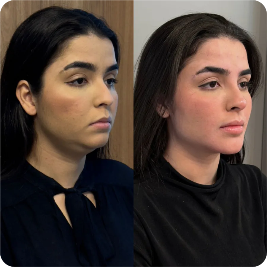 Antes e depois: harmonização facial