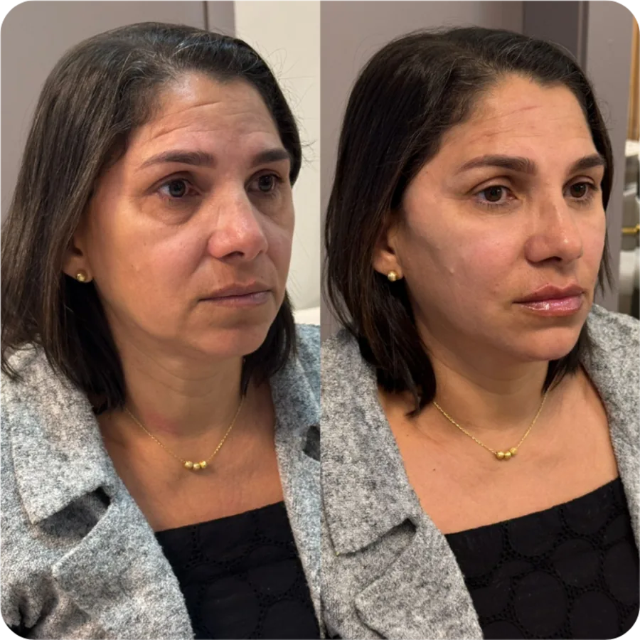 Antes e depois: harmonização facial