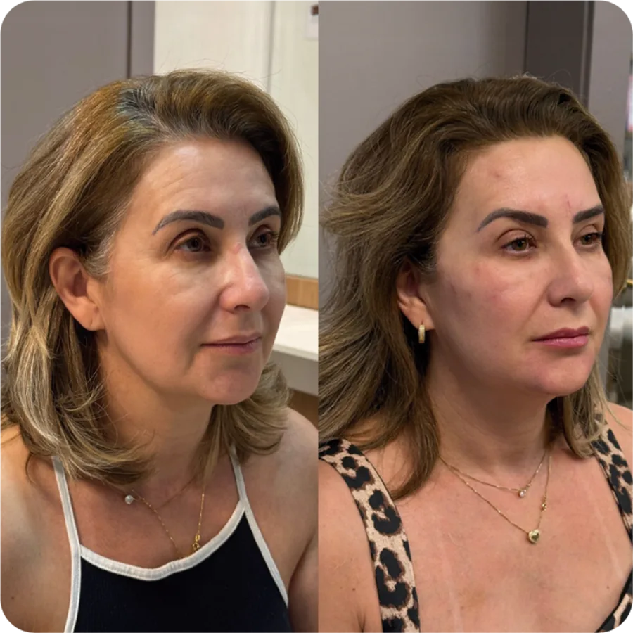 Antes e depois: harmonização facial